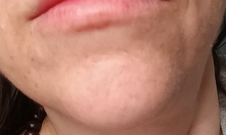 Rigonfiamento mento a distanza di mesi dal filler - 84156