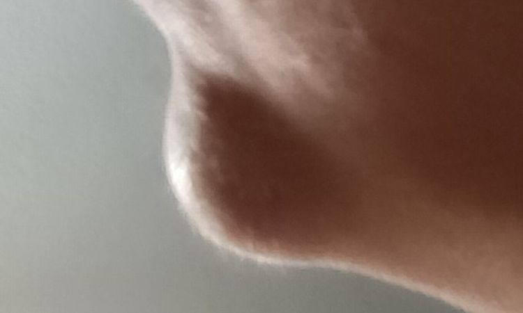 Rigonfiamento mento a distanza di mesi dal filler - 84157