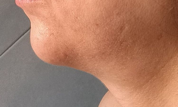 Rigonfiamento mento a distanza di mesi dal filler - 84158