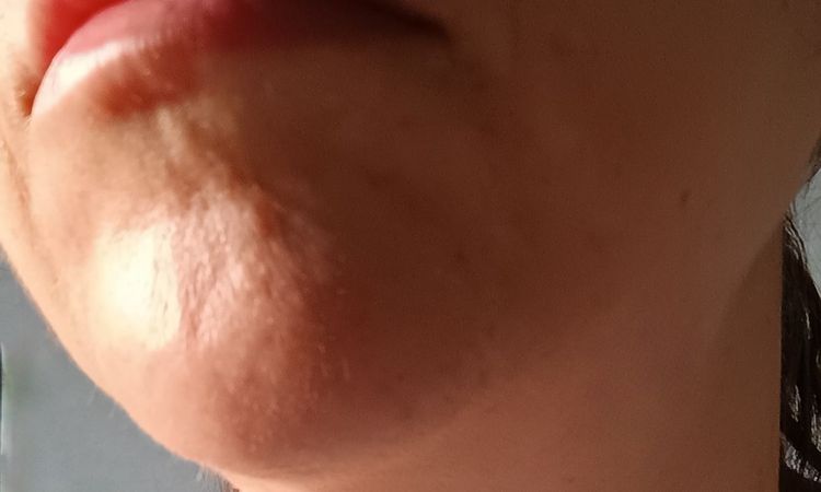 Rigonfiamento mento a distanza di mesi dal filler - 84159