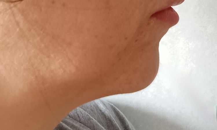 Rigonfiamento mento a distanza di mesi dal filler - 84160