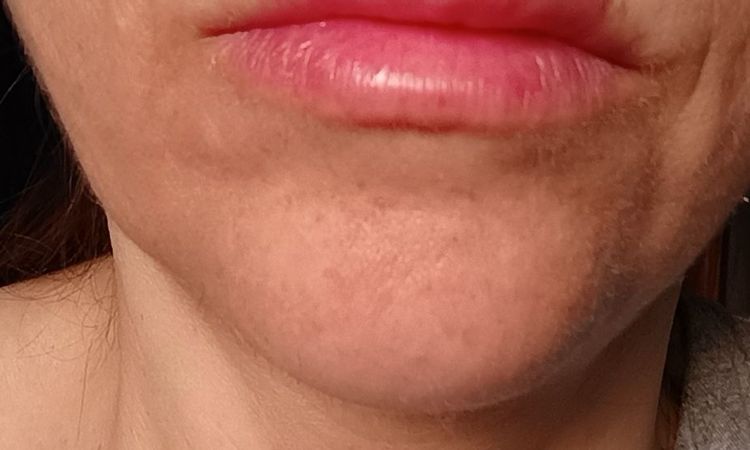 Rigonfiamento mento a distanza di mesi dal filler - 84161