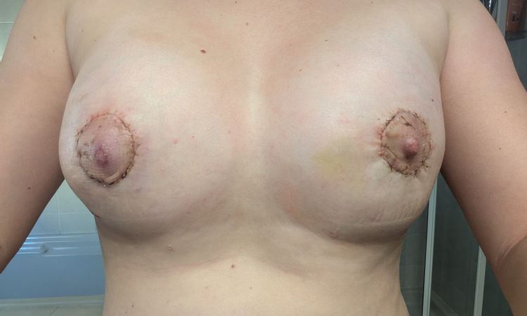 Mastoplastica correttiva per seno tuberoso - 84187