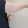 Atrofia da cutanea da cortisone