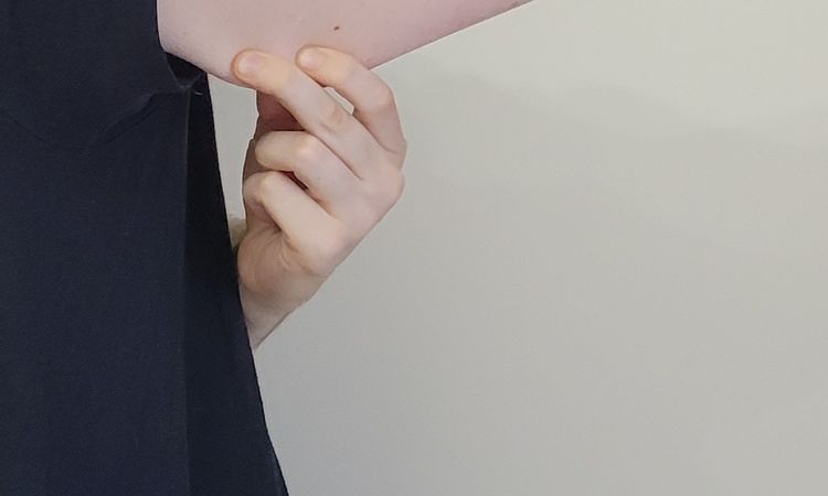 Atrofia da cutanea da cortisone - 84247