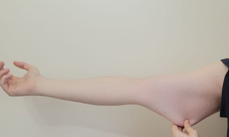 Atrofia da cutanea da cortisone - 84248