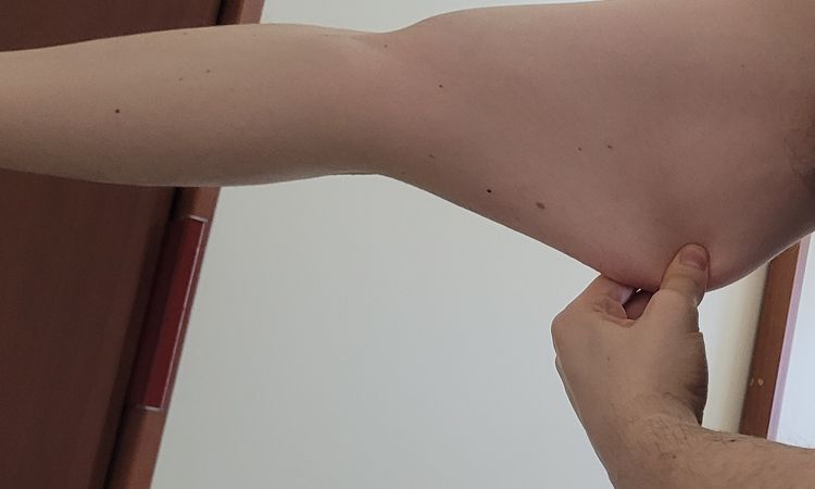 Atrofia da cutanea da cortisone - 84249