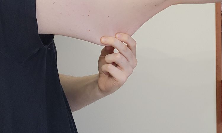 Atrofia da cutanea da cortisone - 84250