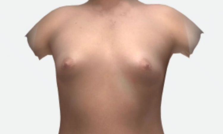 Polo inferiore piatto e areole differenti dopo mastoplastica - 84345