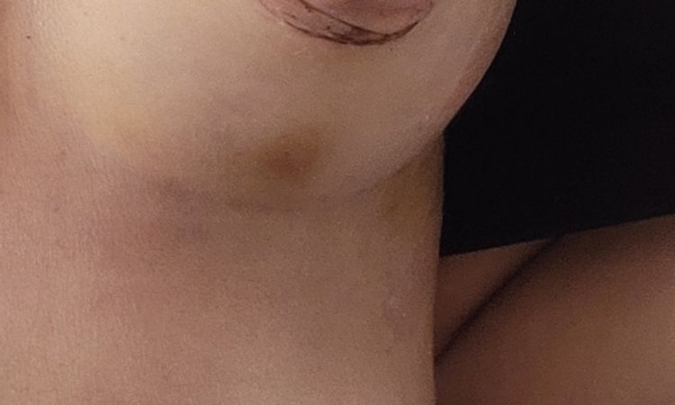Polo inferiore piatto e areole differenti dopo mastoplastica - 84347