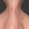 Callo osseo, fibrosi, infossazione o intervento errato?