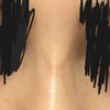 Callo osseo, fibrosi, infossazione o intervento errato?