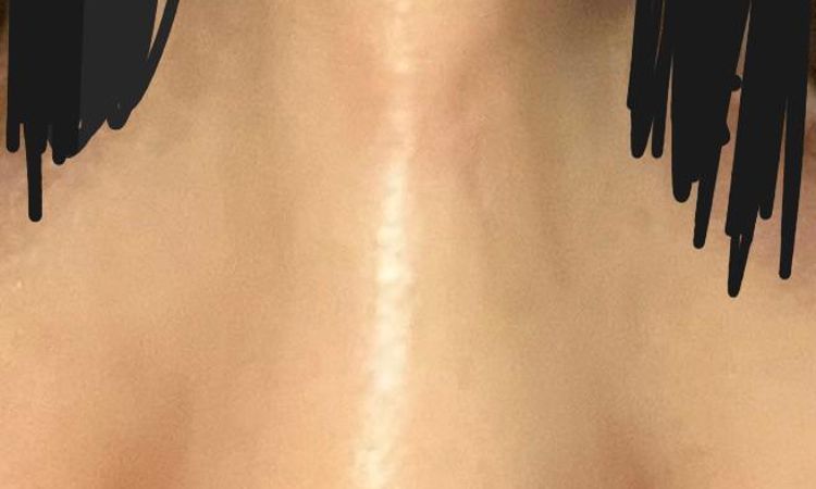 Callo osseo, fibrosi, infossazione o intervento errato? - 84386