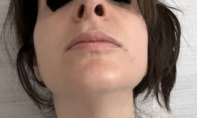 Differenza narici post rinosettoplastica - 84401