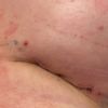 E’ normale l’affossamento tra cicatrice e mammella?