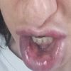 Dubbio necrosi post filler labbra