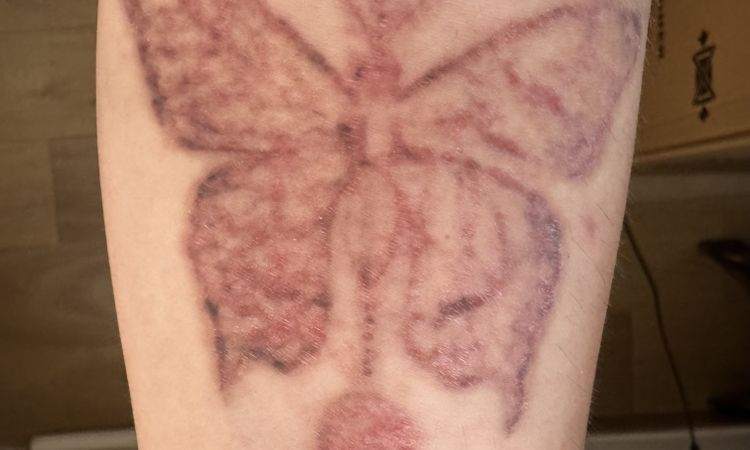 il tatuaggio nero è ancora evidente e la pelle è molto arrossata. Consigli? - 84597