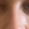 Old rhinoplasty (3 years) cortisone injection possible?