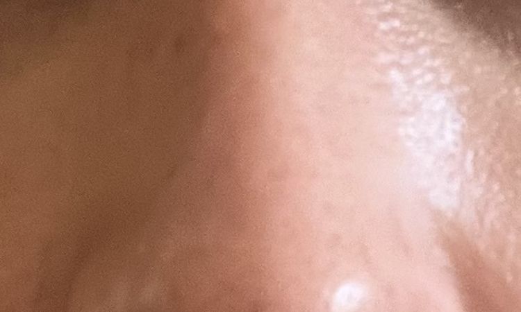 Old rhinoplasty (3 years) cortisone injection possible? - 84630