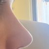 Old rhinoplasty (3 years) cortisone injection possible?