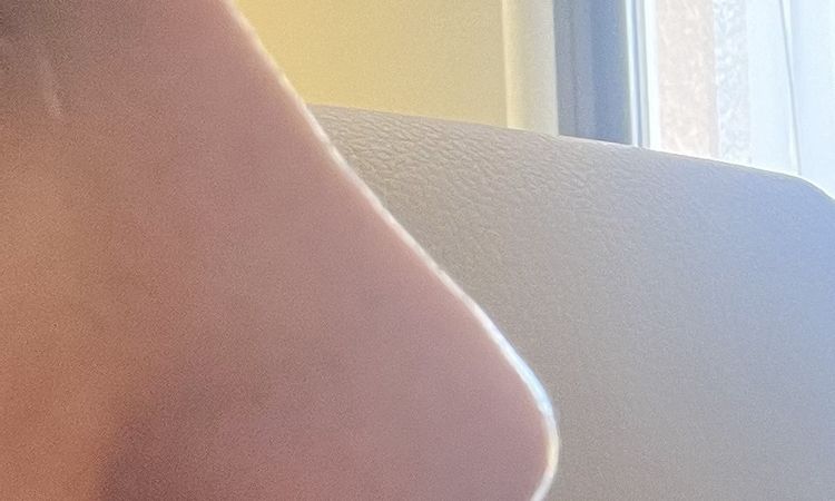 Old rhinoplasty (3 years) cortisone injection possible? - 84631
