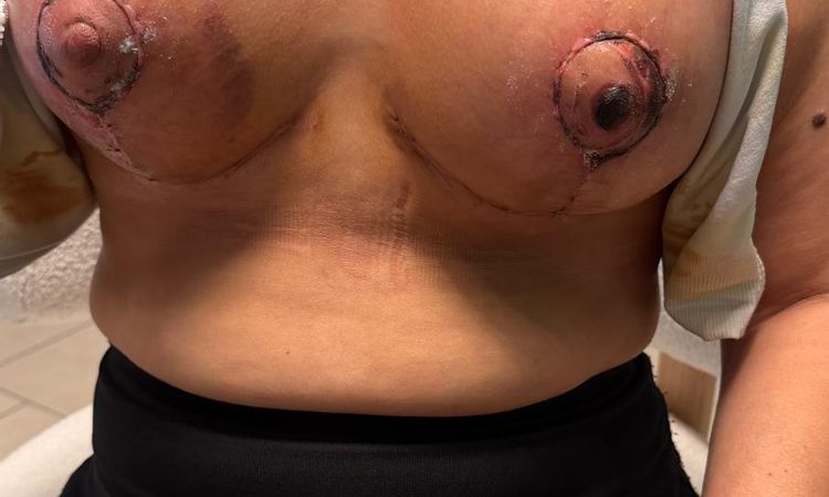 Capezzolo scuro dopo mastopessi con protesi - 84802