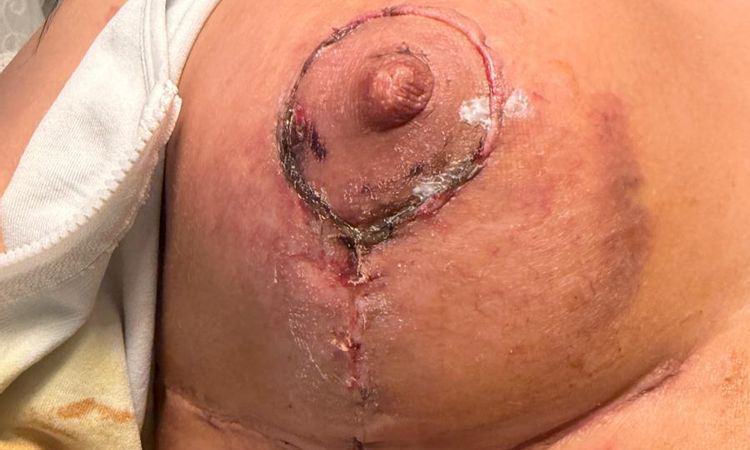 Capezzolo scuro dopo mastopessi con protesi - 84803