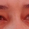 Post Blefaroplastica inferiore
