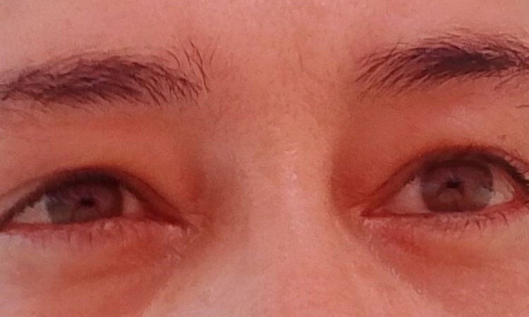 Post Blefaroplastica inferiore - 84816