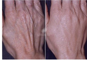 Ringiovanimento mani