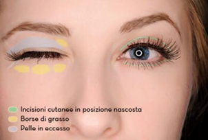 Come si fa la blefaroplastica