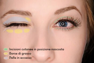 Come si fa la blefaroplastica