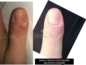 verruche appena nate