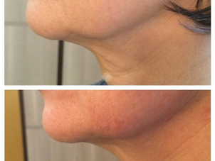 Rimodellamento dell'ovale con tecnica needling