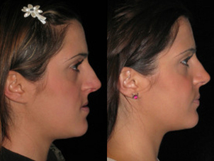 Prima e dopo intervento di chirurgia maxillo - facciale