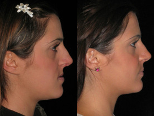 Prima e dopo intervento di chirurgia maxillo - facciale