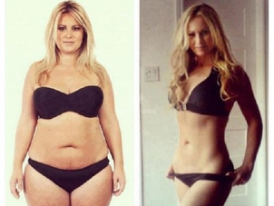 Ridurre lo stomaco chirurgicamente