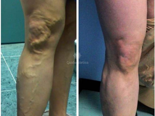 Trattamento vene varicose risultati