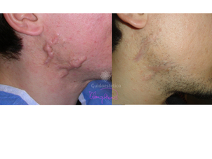 Risultati di trattamento di cheloidi