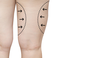 La liposuzione chirurgica può eliminare il tessuto adiposo sottocutaneo aumentato