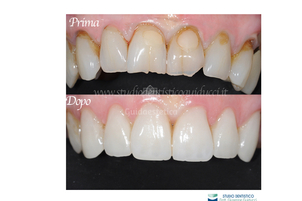 Risultato faccette dentali