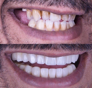 Risultato faccette dentali