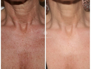 Peeling decolleté risultati