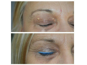 Xantelasmi rimozione