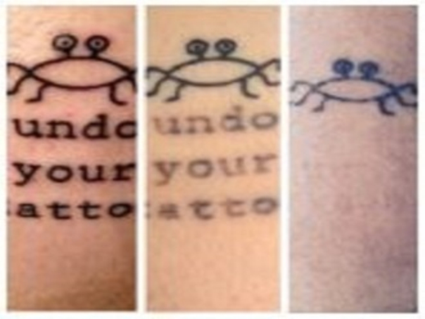Risultati progressivi eliminazione tatuaggio
