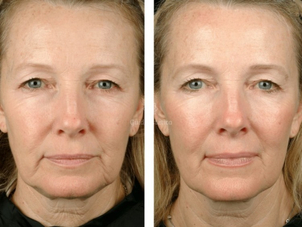 Eliminare rughe d'espressione