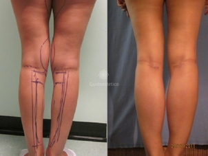 Mioplastica polpacci prima e dopo