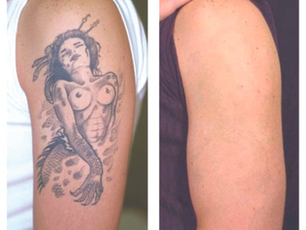 Risultati rimozione tatuaggio sul braccio