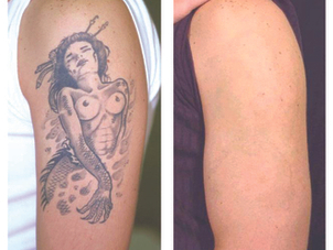 Risultati rimozione tatuaggio sul braccio