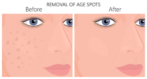 microdermoabrasione